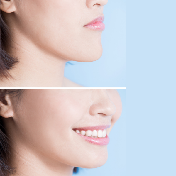 Forehead-lift